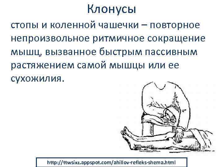 Клонусы стопы и коленной чашечки – повторное непроизвольное ритмичное сокращение мышц, вызванное быстрым пассивным