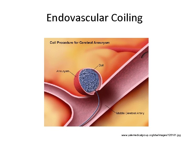 Endovascular Coiling www. yalemedicalgroup. org/stw/images/126181. jpg 