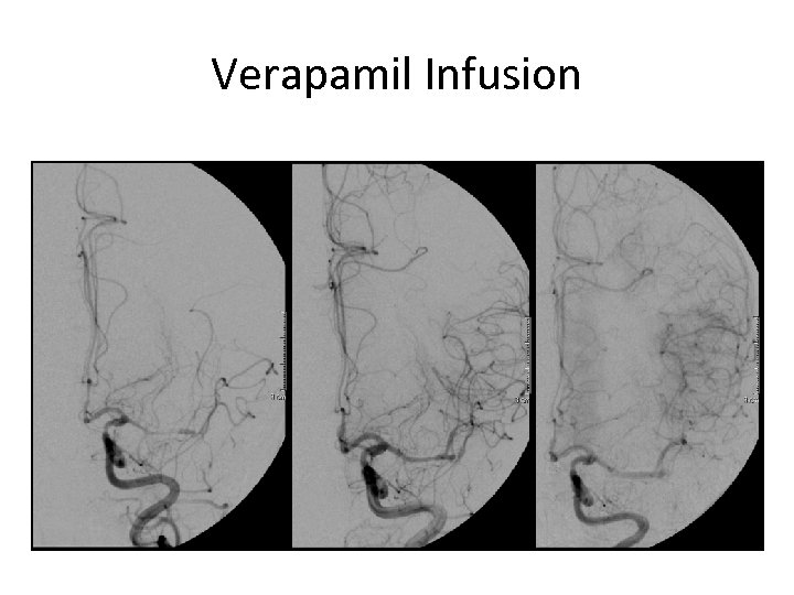 Verapamil Infusion 