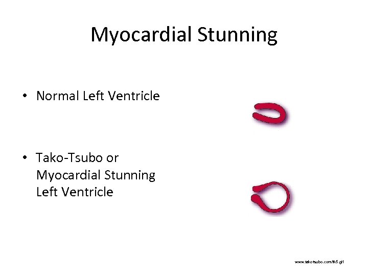 Myocardial Stunning • Normal Left Ventricle • Tako-Tsubo or Myocardial Stunning Left Ventricle www.