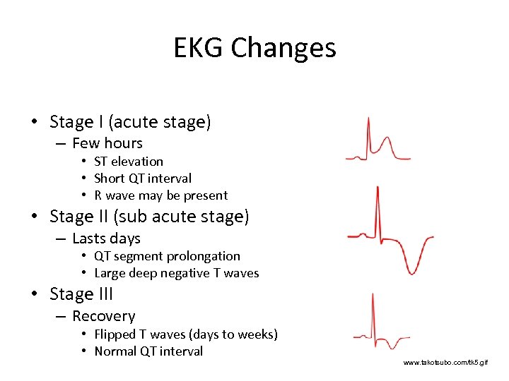 EKG Changes • Stage I (acute stage) – Few hours • ST elevation •