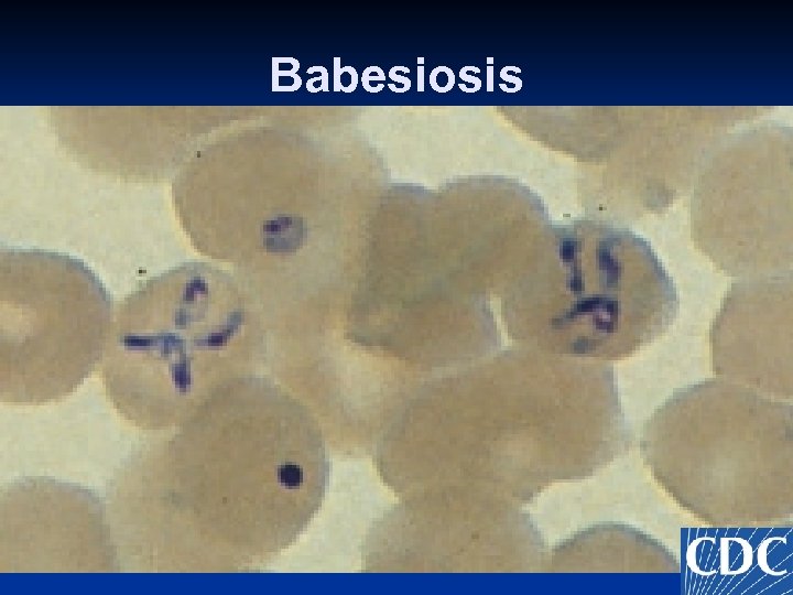 Babesiosis 