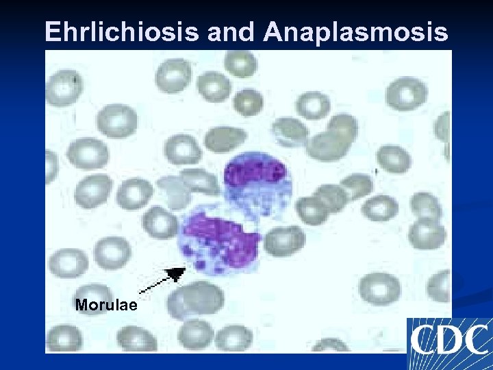 Ehrlichiosis and Anaplasmosis Morulae 