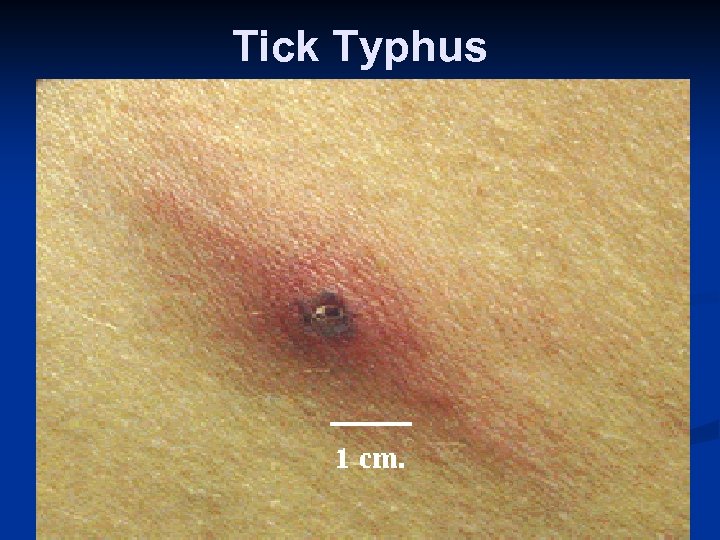 Tick Typhus 