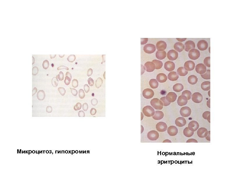 Микроцитоз, гипохромия Нормальные эритроциты 