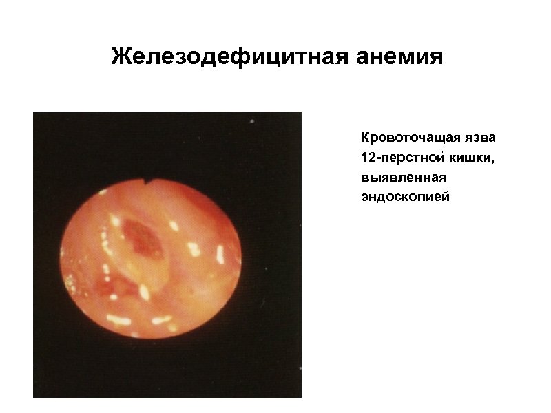 Железодефицитная анемия Кровоточащая язва 12 -перстной кишки, выявленная эндоскопией 