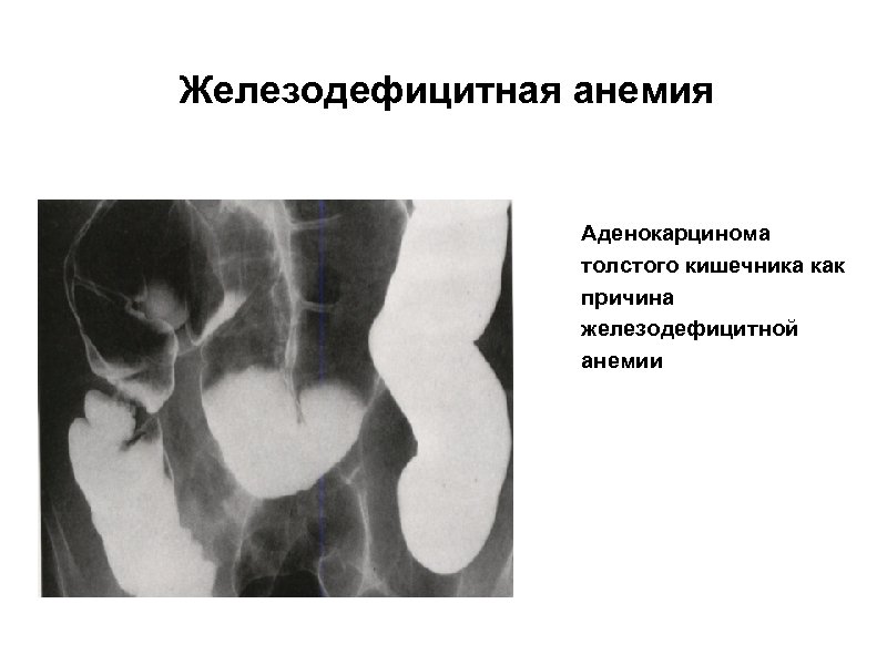 Железодефицитная анемия Аденокарцинома толстого кишечника как причина железодефицитной анемии 