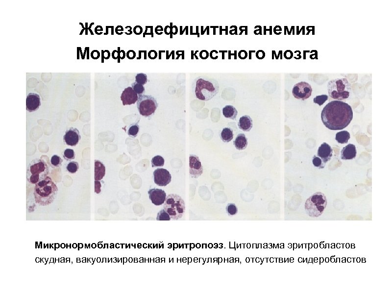 Железодефицитная анемия Морфология костного мозга Микронормобластический эритропоэз. Цитоплазма эритробластов скудная, вакуолизированная и нерегулярная, отсутствие