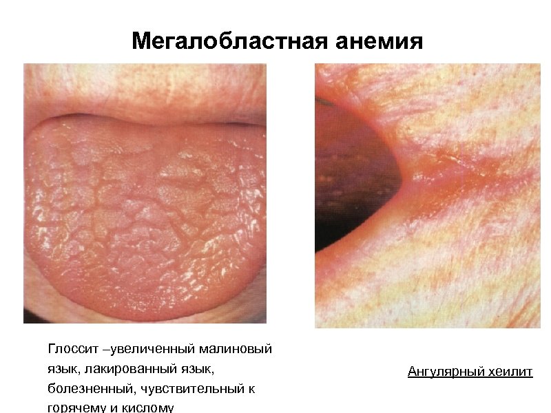 Мегалобластная анемия Глоссит –увеличенный малиновый язык, лакированный язык, болезненный, чувствительный к горячему и кислому