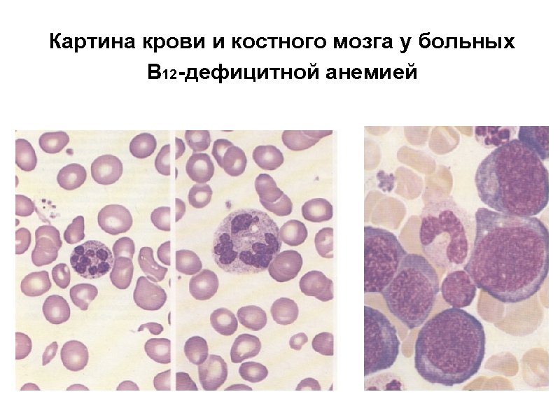 Картина крови и костного мозга у больных В 12 -дефицитной анемией 