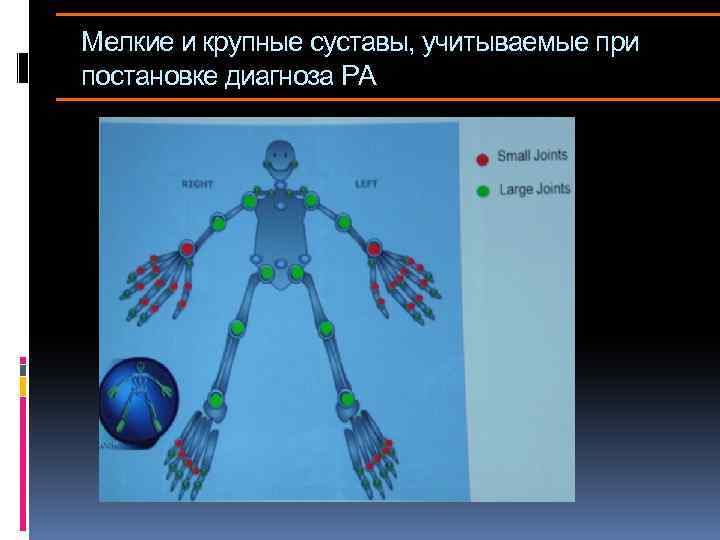 Мелкие и крупные суставы, учитываемые при постановке диагноза РА 