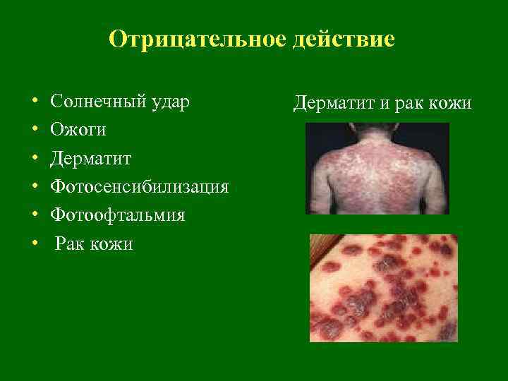 Отрицательное действие • • • Солнечный удар Ожоги Дерматит Фотосенсибилизация Фотоофтальмия Рак кожи Дерматит