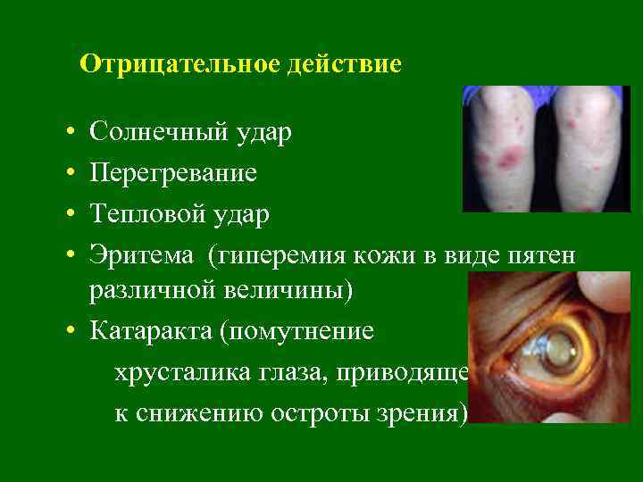 Отрицательное действие • • Солнечный удар Перегревание Тепловой удар Эритема (гиперемия кожи в виде