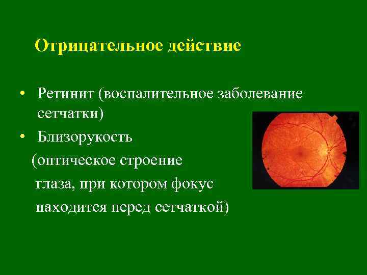 Отрицательное действие • Ретинит (воспалительное заболевание сетчатки) • Близорукость (оптическое строение глаза, при котором