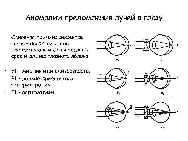 Преломляет лучи в глазу. Аномалии преломления лучей в глазу дальнозоркость и близорукость. Аномалии преломления лучей в глазу. Аномалии преломления лучей в глазном яблоке. Схема хода лучей в глазном яблоке.