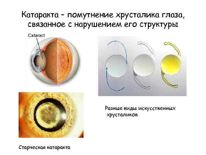 Катаракта – помутнение хрусталика глаза, связанное с нарушением его структуры Разные виды искусственных хрусталиков