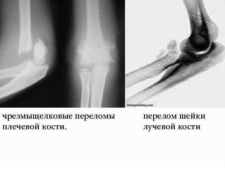чрезмыщелковые переломы плечевой кости. перелом шейки лучевой кости 