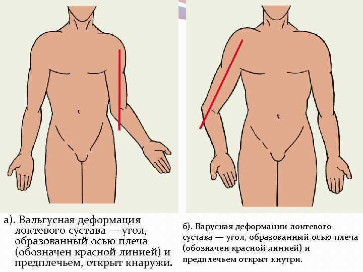 а). Вальгусная деформация локтевого сустава — угол, образованный осью плеча (обозначен красной линией) и