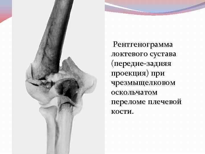  Рентгенограмма локтевого сустава (передне-задняя проекция) при чрезмыщелковом оскольчатом переломе плечевой кости. 