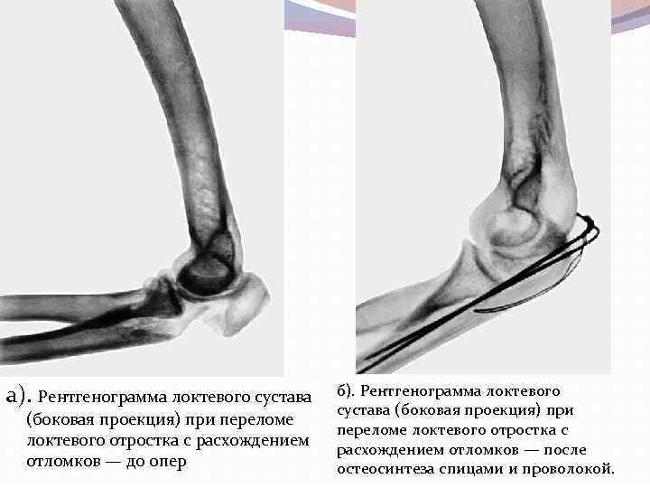 а). Рентгенограмма локтевого сустава (боковая проекция) при переломе локтевого отростка с расхождением отломков —