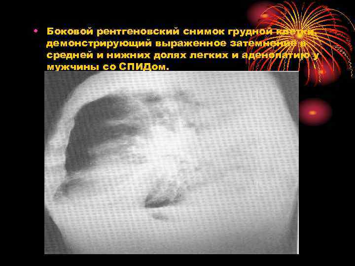  • Боковой рентгеновский снимок грудной клетки, демонстрирующий выраженное затемнение в средней и нижних