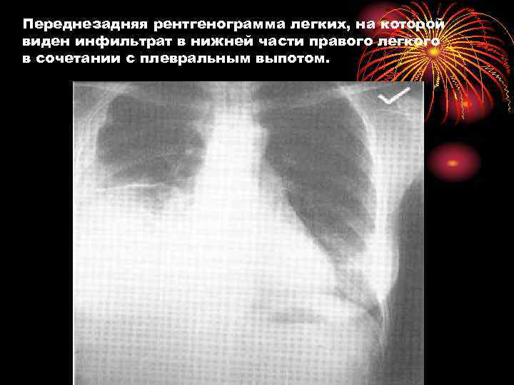 Переднезадняя рентгенограмма легких, на которой виден инфильтрат в нижней части правого легкого в сочетании