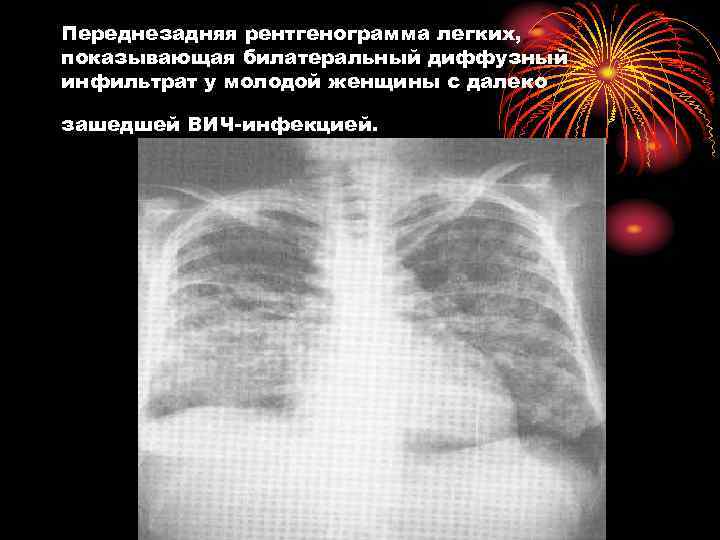 Переднезадняя рентгенограмма легких, показывающая билатеральный диффузный инфильтрат у молодой женщины с далеко зашедшей ВИЧ