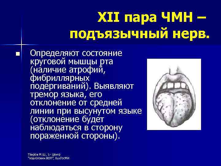 XII пара ЧМН – подъязычный нерв. n Определяют состояние круговой мышцы рта (наличие атрофий,