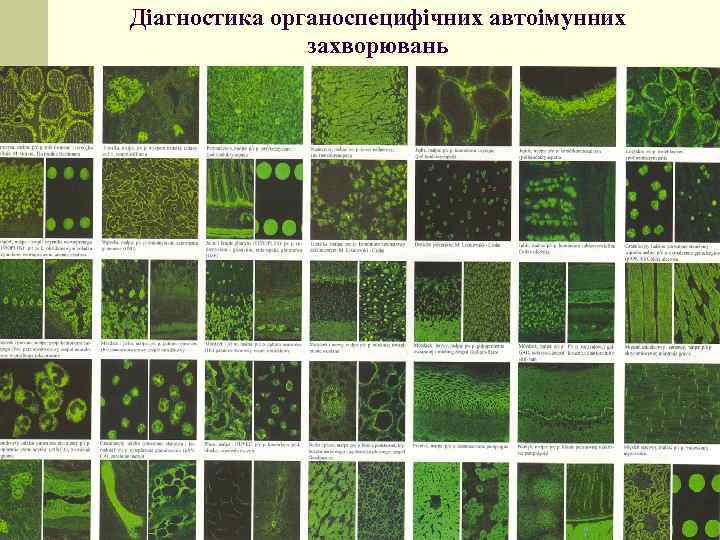 Діагностика органоспецифічних автоімунних захворювань 