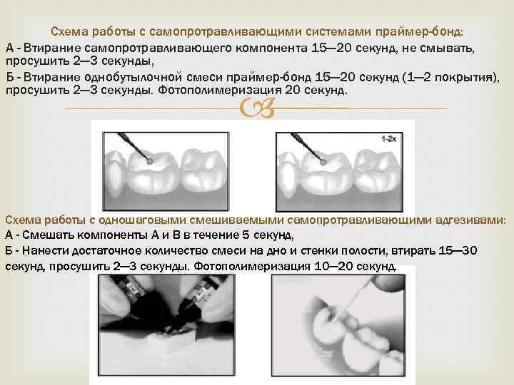 Адгезивные системы в стоматологии презентация