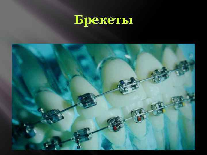Брекеты 