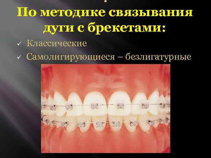  По методике связывания дуги с брекетами: ü ü Классические Самолигирующиеся – безлигатурные 
