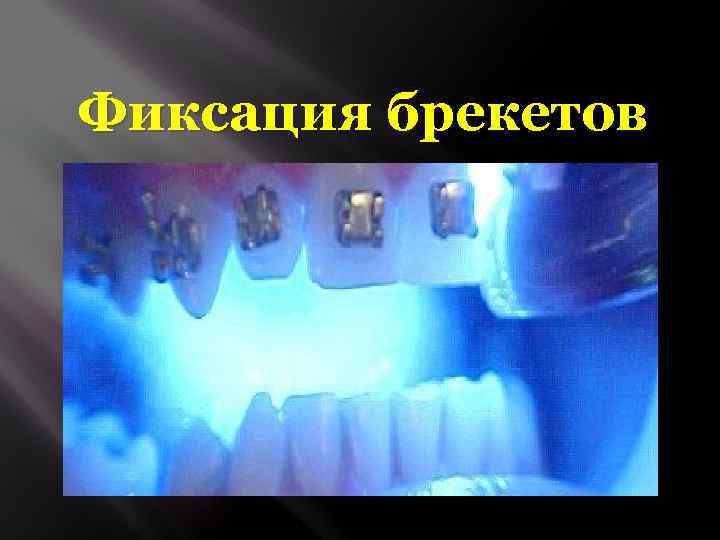 Фиксация брекетов 