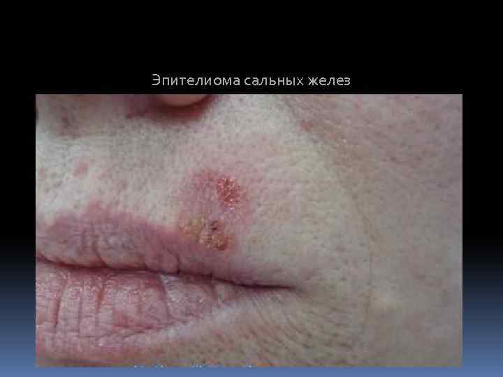 Эпителиома сальных желез 