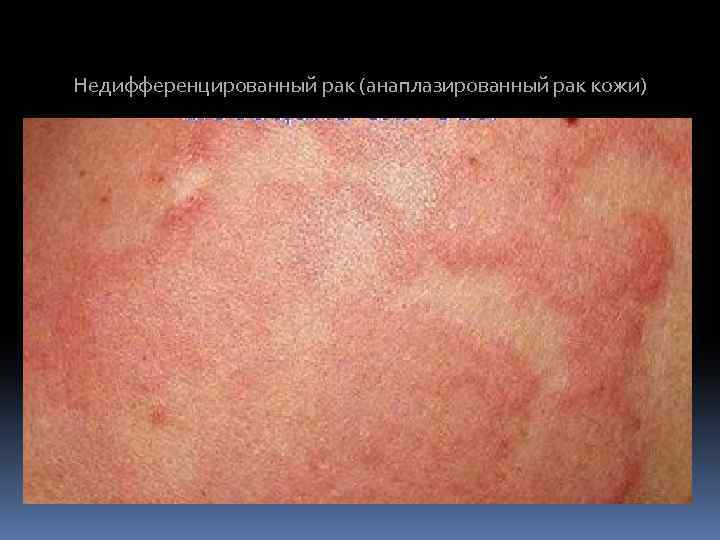 Недифференцированный рак (анаплазированный рак кожи) 