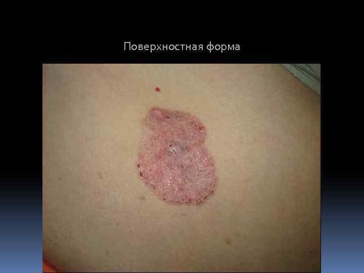 Поверхностная форма 