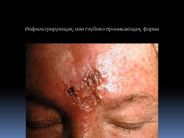 Инфильтрирующая, или глубоко проникающая, форма 