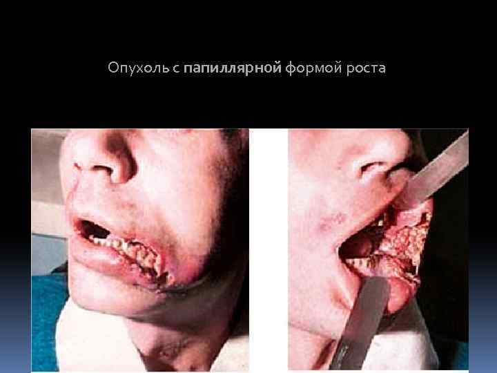 Опухоль с папиллярной формой роста 