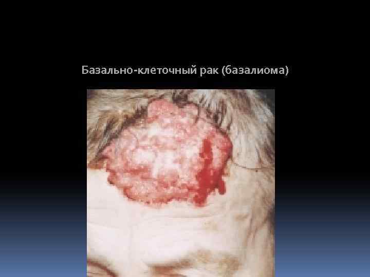 Базально-клеточный рак (базалиома) 