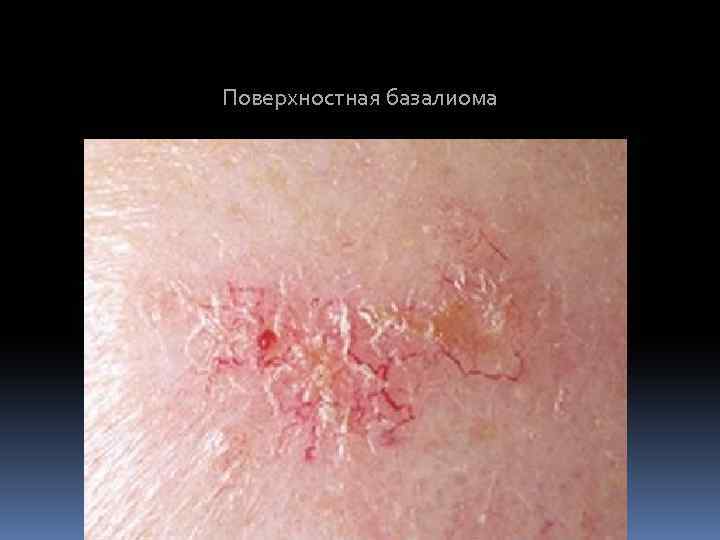 Поверхностная базалиома 