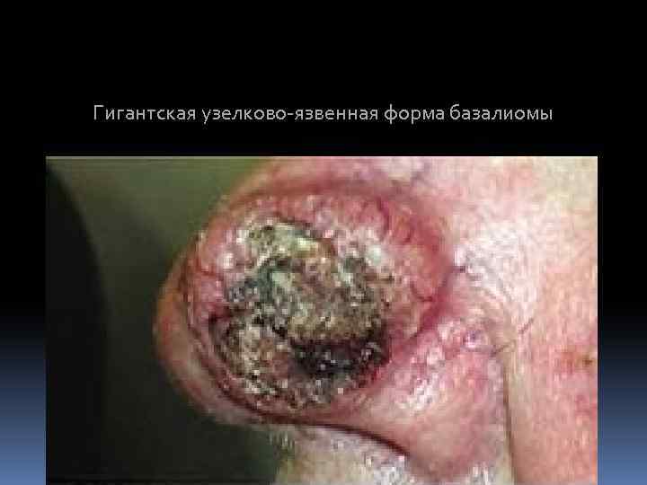 Гигантская узелково-язвенная форма базалиомы 