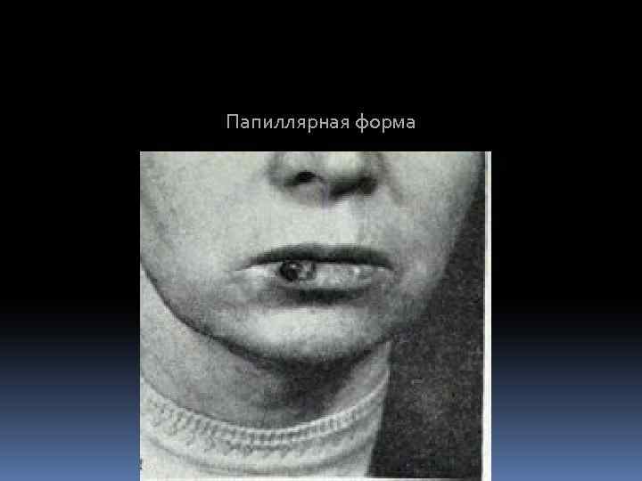 Папиллярная форма 