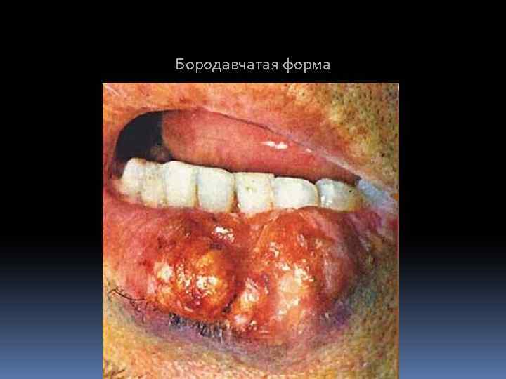 Бородавчатая форма 