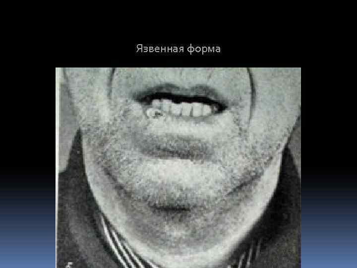 Язвенная форма 