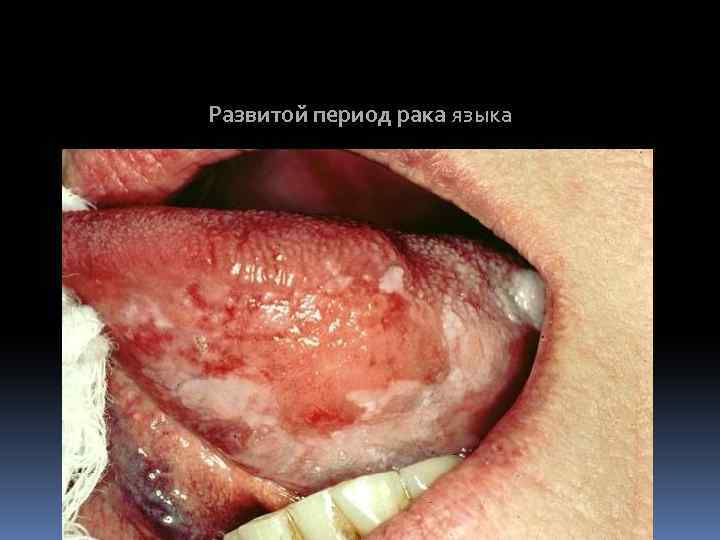 Развитой период рака языка 