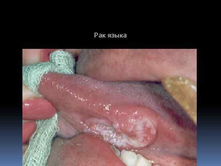Рак языка 