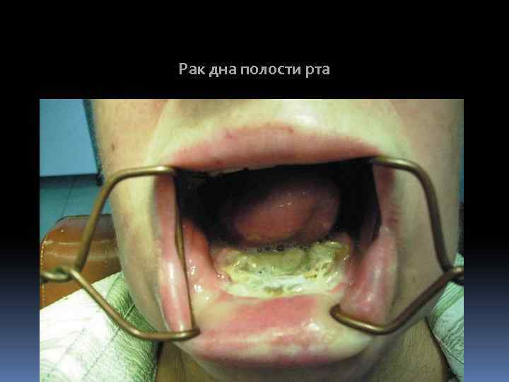 Рак дна полости рта 