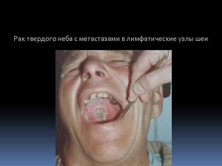 Рак твердого неба с метастазами в лимфатические узлы шеи 