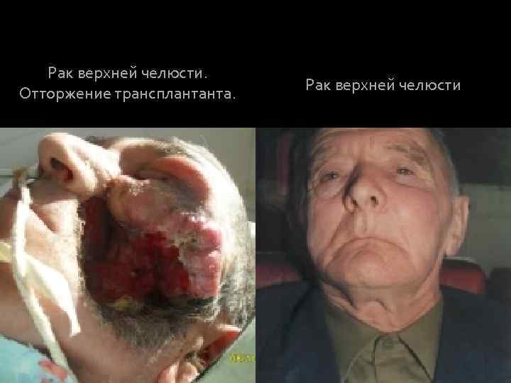 Рак верхней челюсти. Отторжение трансплантанта. Рак верхней челюсти 