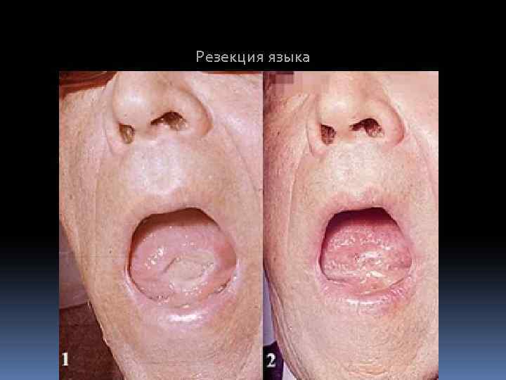 Резекция языка 